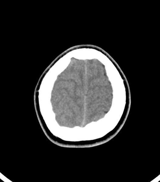 File:Choroid plexus carcinoma (Radiopaedia 91013-108552 Axial non-contrast 54).jpg