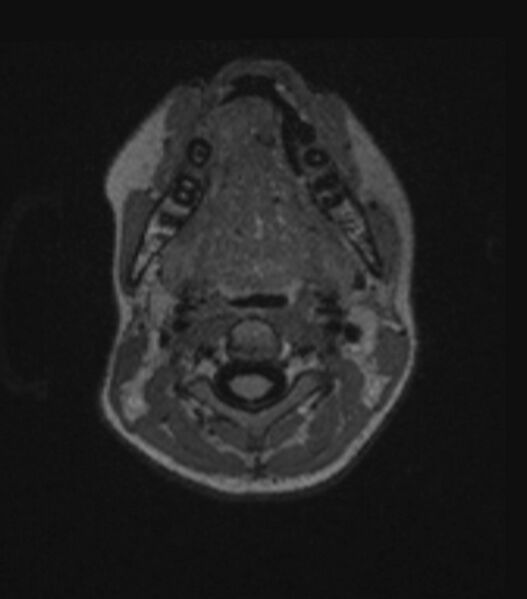 File:Choroid plexus carcinoma (Radiopaedia 91013-108553 Axial FLAIR C+ 35).jpg