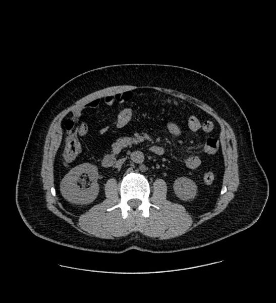 File:Chromophobe renal cell carcinoma (Radiopaedia 84337-99693 Axial non-contrast 60).jpg