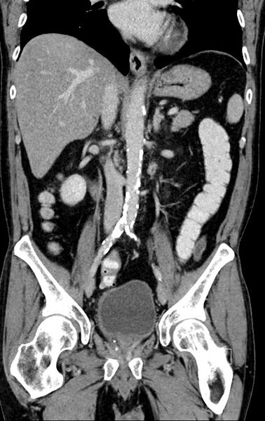 File:Chronic appendicitis complicated by appendicular abscess, pylephlebitis and liver abscess (Radiopaedia 54483-60700 C 44).jpg