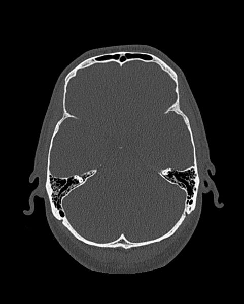 File:Chronic maxillary sinusitis caused by a foreign body (Radiopaedia 58521-65676 Axial bone window 284).jpg
