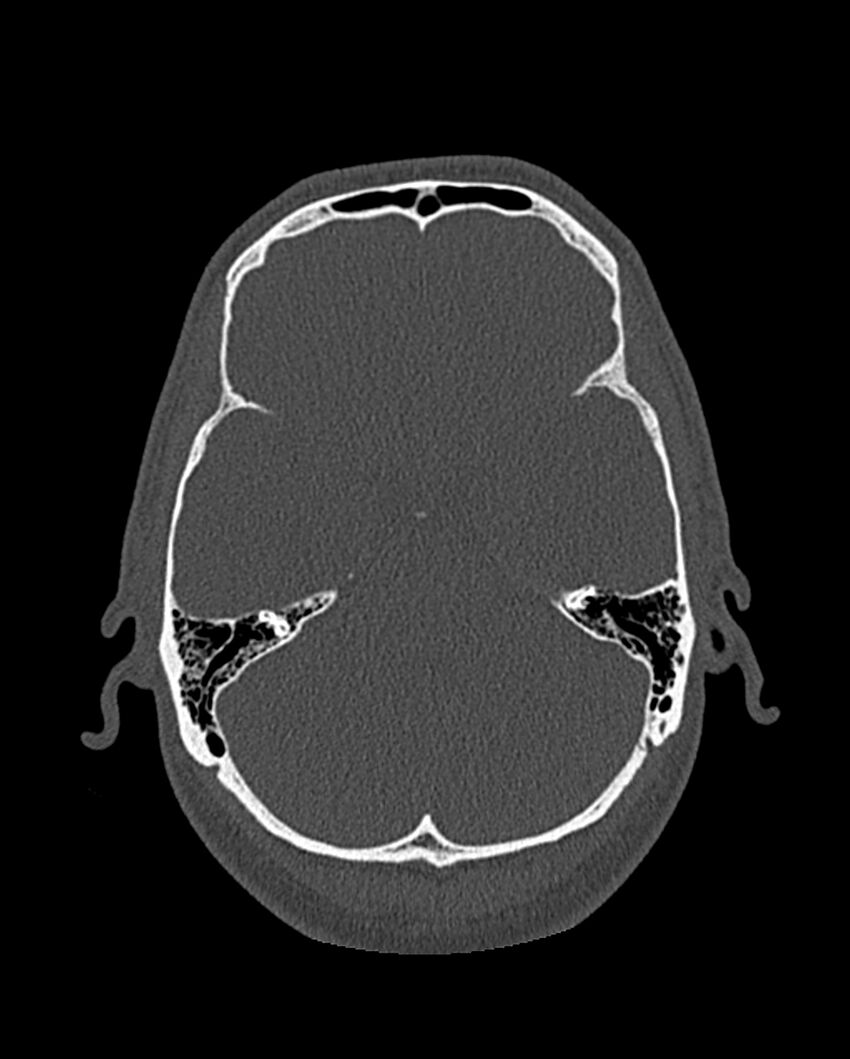 Chronic maxillary sinusitis caused by a foreign body (Radiopaedia 58521-65676 Axial bone window 284).jpg