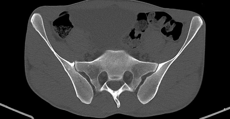 File:Chronic osteomyelitis (with sequestrum) (Radiopaedia 74813-85822 Axial non-contrast 6).jpg