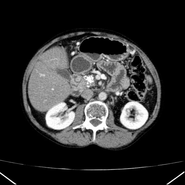 File:Chronic pancreatitis (Radiopaedia 23132-23172 B 25).jpg
