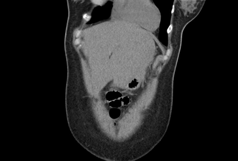 File:Chronic pancreatitis - pancreatic duct calculi (Radiopaedia 71818-82251 Coronal non-contrast 4).jpg