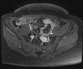 Class II Mullerian duct anomaly- unicornuate uterus with rudimentary horn and non-communicating cavity (Radiopaedia 39441-41755 Axial T1 fat sat 21).jpg