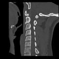 Clay-shoveler fracture (Radiopaedia 22568-22590 Sagittal bone window 27).jpg