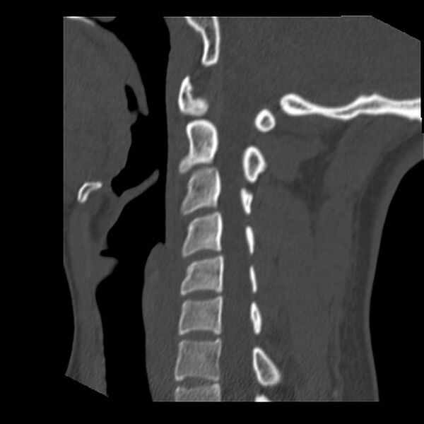 File:Clay-shoveler fracture (Radiopaedia 22568-22590 Sagittal bone window 27).jpg
