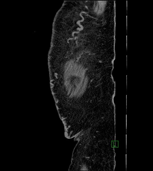 File:Closed-loop small bowel obstruction-internal hernia (Radiopaedia 78439-91096 C 13).jpg