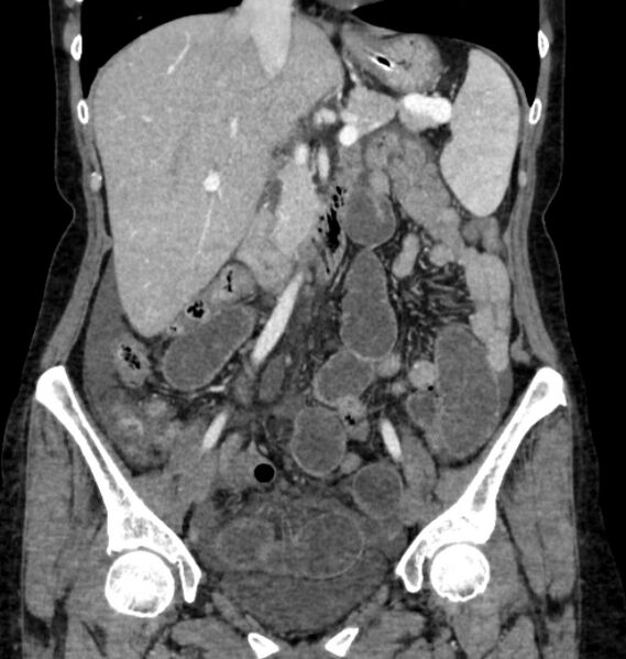 File:Closed loop small bowel obstruction (Radiopaedia 71211-81508 B 52).jpg