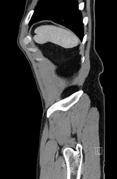 File:Closed loop small bowel obstruction - internal hernia (Radiopaedia 57806-64778 C 17).jpg