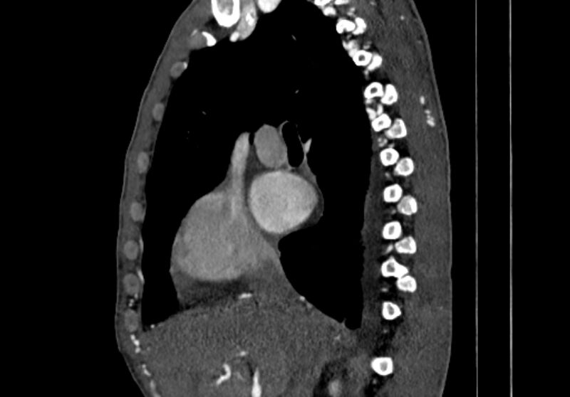 File:Coarctation of aorta with aortic valve stenosis (Radiopaedia 70463-80574 B 12).jpg