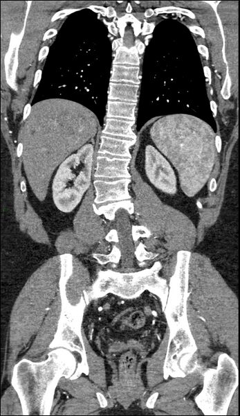File:Coarctation of the aorta (Radiopaedia 74632-88521 B 176).jpg