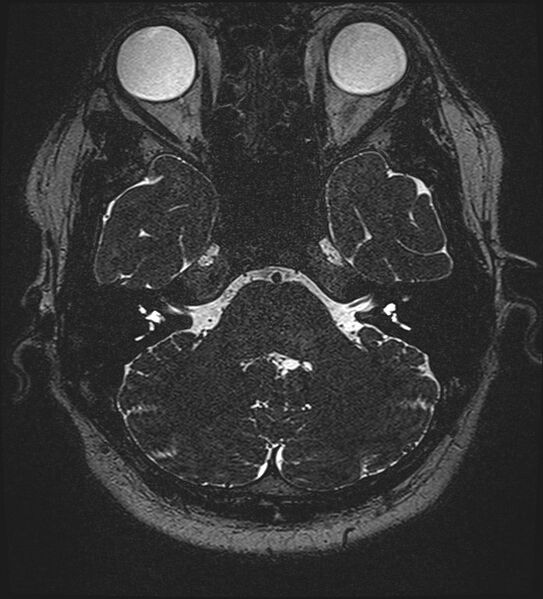 File:Cochlear incomplete partition type III associated with hypothalamic hamartoma (Radiopaedia 88756-105498 Axial T2 77).jpg