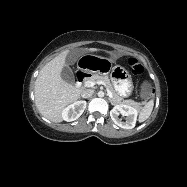 File:Cocoon abdomen with possible tubo-ovarian abscess (Radiopaedia 46235-50636 A 12).png