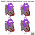 Collett and Edwards classification of truncus arteriosus (diagram) (Radiopaedia 51895-57733 A 1).png