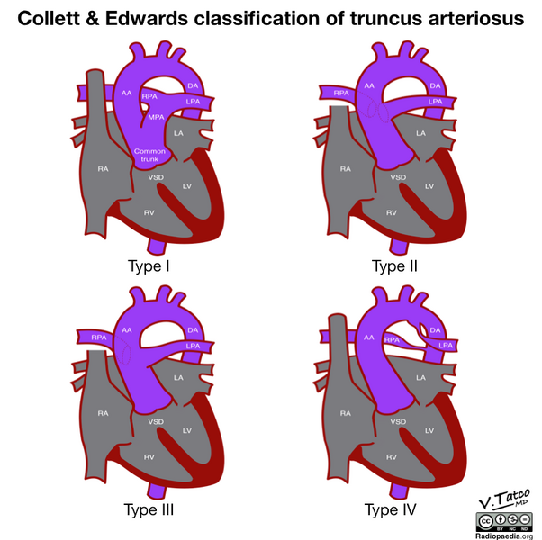 File:Collett and Edwards classification of truncus arteriosus (diagram) (Radiopaedia 51895-57733 A 1).png