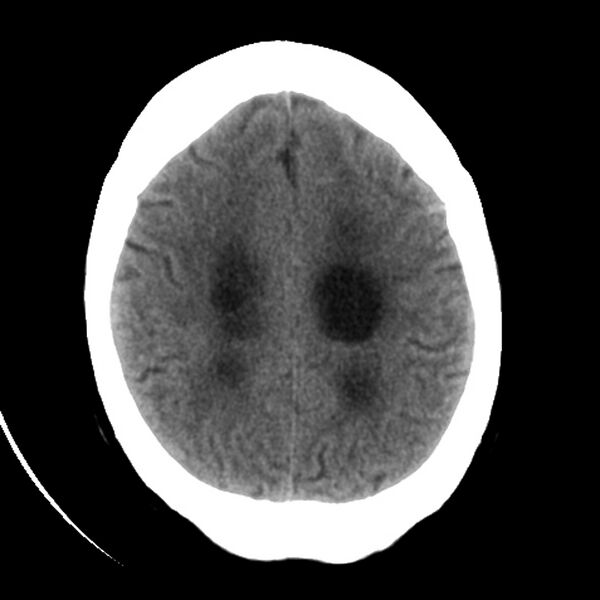 File:Colloid cyst with hydrocephalus (Radiopaedia 9373-10064 Axial non-contrast 14).jpg