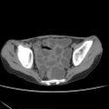 Colocolic fistula - Crohn disease (Radiopaedia 57063-63955 A 78).jpg