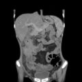Colocolic fistula - Crohn disease (Radiopaedia 57063-63955 B 15).jpg