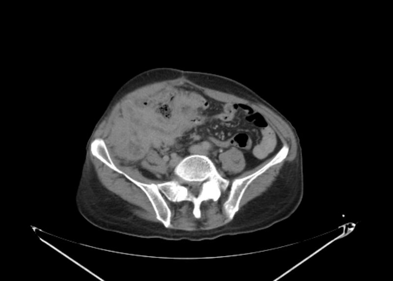 File:Colon cancer mimicking renal cell carcinoma (Radiopaedia 28986-29335 Axial C+ delayed 53).jpg