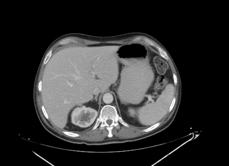 File:Colon cancer mimicking renal cell carcinoma (Radiopaedia 28986-29335 C 15).jpg