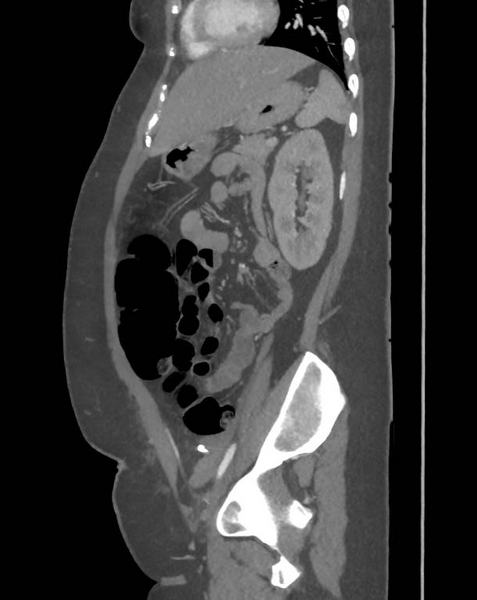 File:Colonic pseudo-obstruction (Radiopaedia 79752-92980 C 53).png