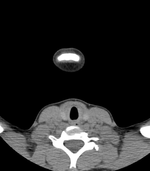 File:Nasoorbitoethmoid fracture (Radiopaedia 90044-107205 Axial non-contrast 10).jpg