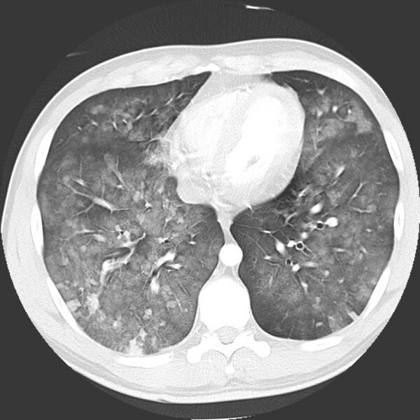 File:Near drowning pulmonary edema (Radiopaedia 16868-16591 Axial lung window 35).jpg