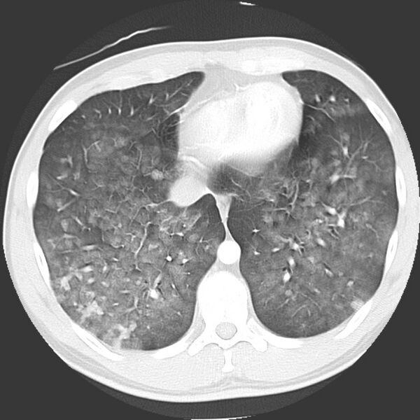 File:Near drowning pulmonary edema (Radiopaedia 16868-16591 Axial lung window 39).jpg