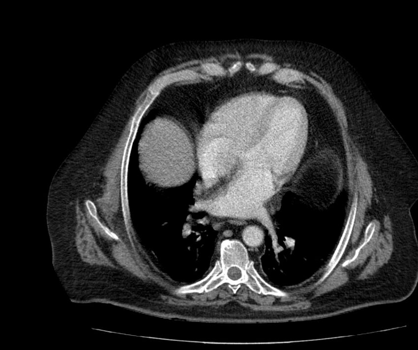 Nephroptosis with inguinal hernia containing perirenal fat (Radiopaedia 56632-63391 C 26).jpg