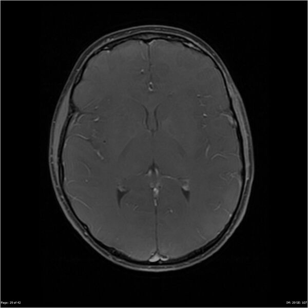 File:Neurofibromatosis type 1 (Radiopaedia 22541-22564 Axial T1 C+ fat sat 29).jpg