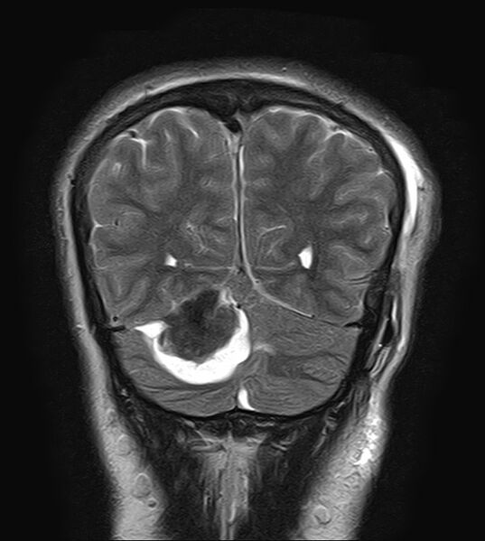 File:Neurofibromatosis type 2 (Radiopaedia 66211-75401 Coronal T2 20).jpg