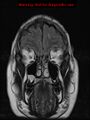 Neuroglial cyst (Radiopaedia 10713-11184 Coronal FLAIR 21).jpg