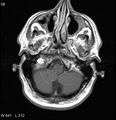 Neurosarcoidosis (Radiopaedia 10930-17204 Axial T1 C+ 2).jpg