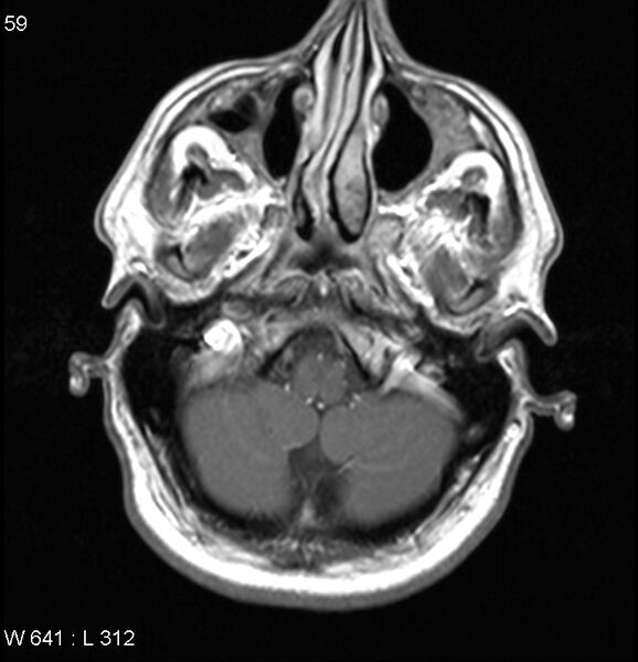 File:Neurosarcoidosis (Radiopaedia 10930-17204 Axial T1 C+ 2).jpg
