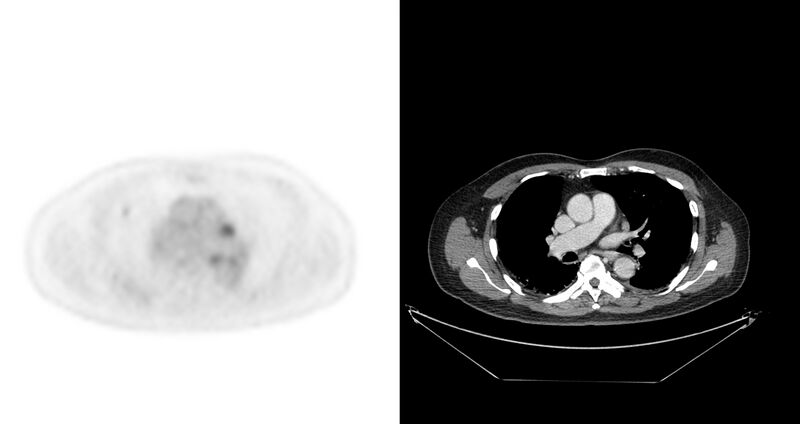 File:Non-Hodgkin lymphoma involving seminal vesicles with development of interstitial pneumonitis during Rituximab therapy (Radiopaedia 32703-33675 axial PET CT 48).jpg
