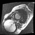 Non-compaction of the left ventricle (Radiopaedia 38868-41062 E 10).jpg