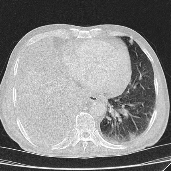 File:Non small-cell lung cancer (Radiopaedia 24467-24769 lung window 36).jpg