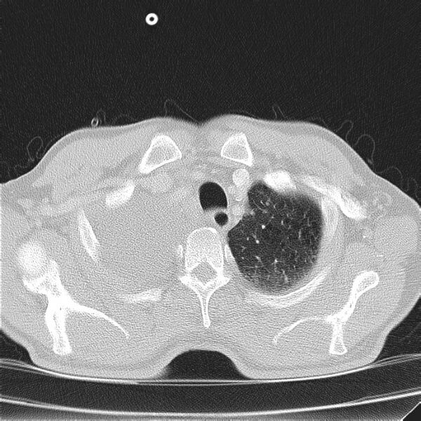 File:Non small-cell lung cancer (Radiopaedia 24467-24769 lung window 5).jpg