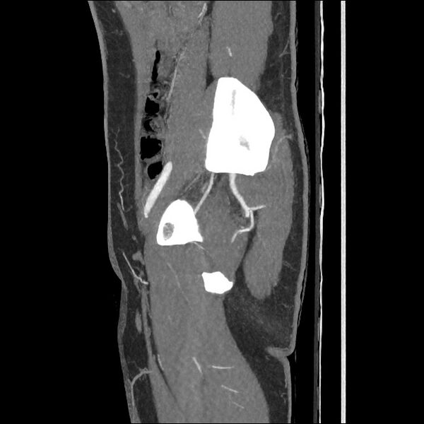 File:Normal CT angiogram of pelvis (Radiopaedia 45390-49430 C 48).jpg