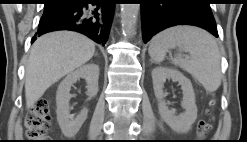 File:Normal CT intravenous cholangiogram (Radiopaedia 38199-40208 Coronal IVC 38).png