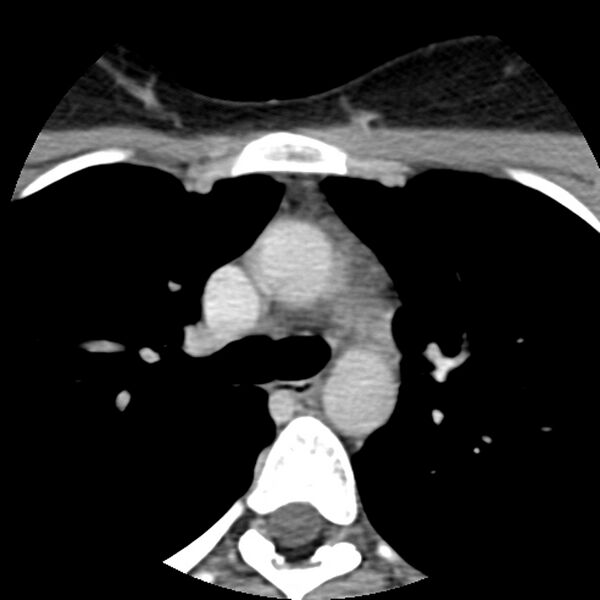 File:Normal CT of the neck (Radiopaedia 14575-14500 Axial C+ 81).jpg