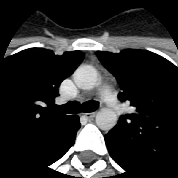 File:Normal CT of the neck (Radiopaedia 14575-14500 Axial C+ 82).jpg