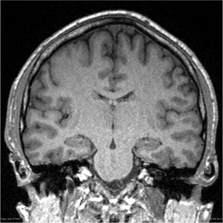 Normal brain MRI (non-focal epilepsy protocol) (Radiopaedia 38571-40700 Coronal T1 52).jpg