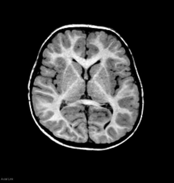 File:Normal myelination 2 year old (Radiopaedia 6815-7983 Axial T1 1).jpg