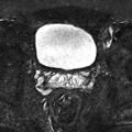 Normal prostate (MRI) (Radiopaedia 29986-30535 Axial STIR 15).jpg