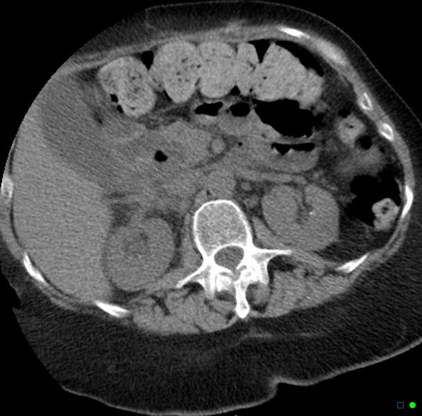 File:Obstructed infected horseshoe kidney (Radiopaedia 18116-17898 non-contrast 5).jpg