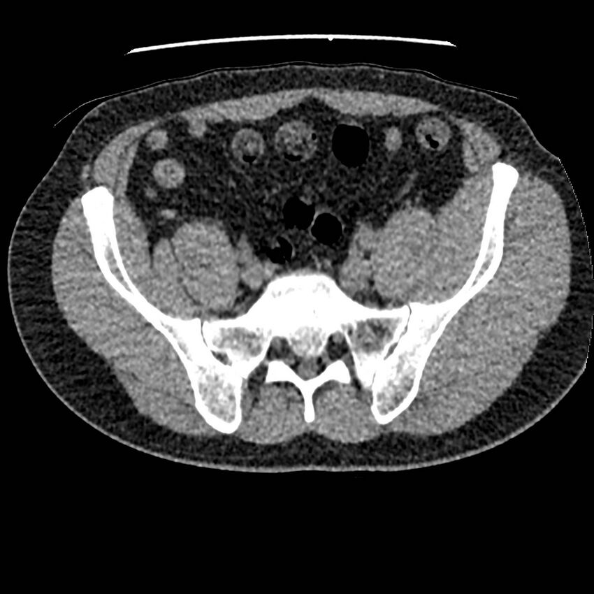 Obstructing ureteric calculus and ureteric anatomy (Radiopaedia 62730-71042 Axial non-contrast 118).jpg