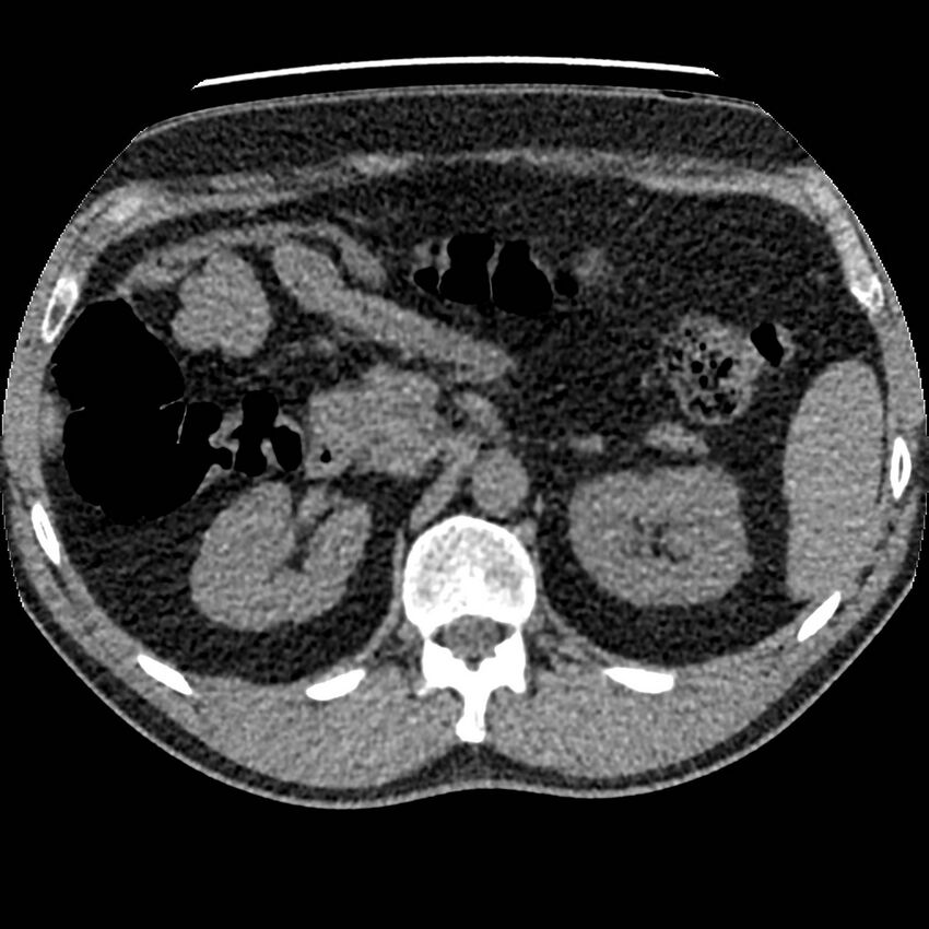 Obstructing ureteric calculus and ureteric anatomy (Radiopaedia 62730-71042 Axial non-contrast 25).jpg